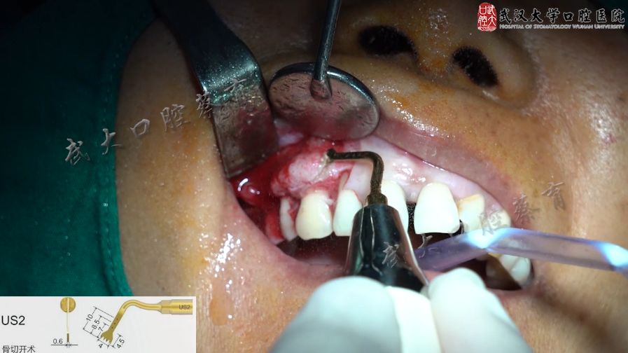 牙槽突骨质增生